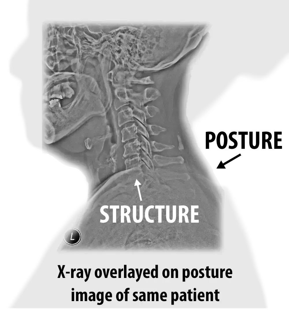 Cervical X-ray overlaid on the same patient’s side-view posture image, showing spinal structure in relation to external neck posture.