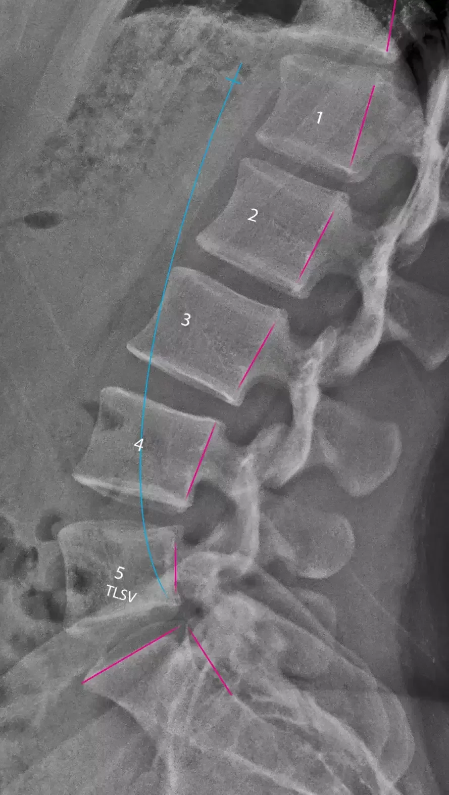 Lateral lumbar X-ray showing pink vertebral alignment lines and a cyan reference curve for comparison of lower-back curvature.