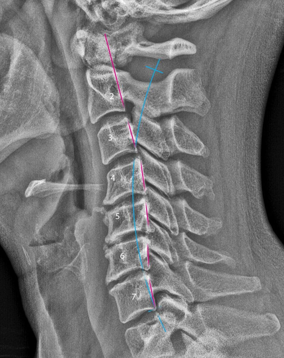 Neck X-ray
