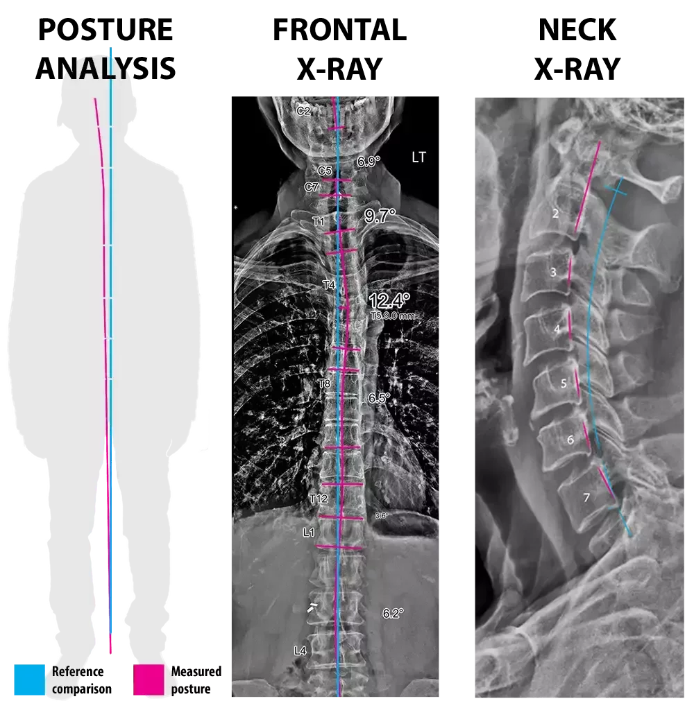 Posture analysis, frontal full-spine X-ray, and lateral neck X-ray with pink measured alignment markers and cyan reference lines.