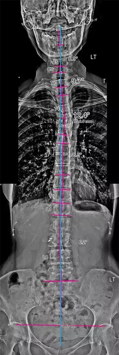 Full-spine front-view X-ray with pink alignment markers, a cyan reference midline, and angle measurements showing lateral spinal curvature.