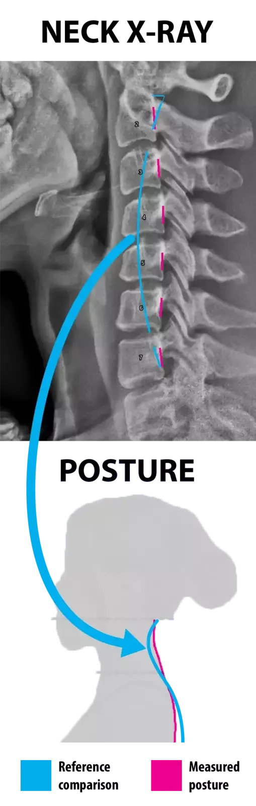 Cervical X-ray and side-view posture silhouette linked by an arrow, with pink measured alignment lines and cyan reference lines.
