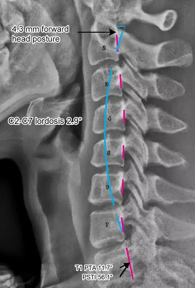 Lateral cervical X-ray with pink alignment markers and a cyan reference curve, annotated with 4.3 mm forward head posture and 2.9° C2–C7 lordosis.