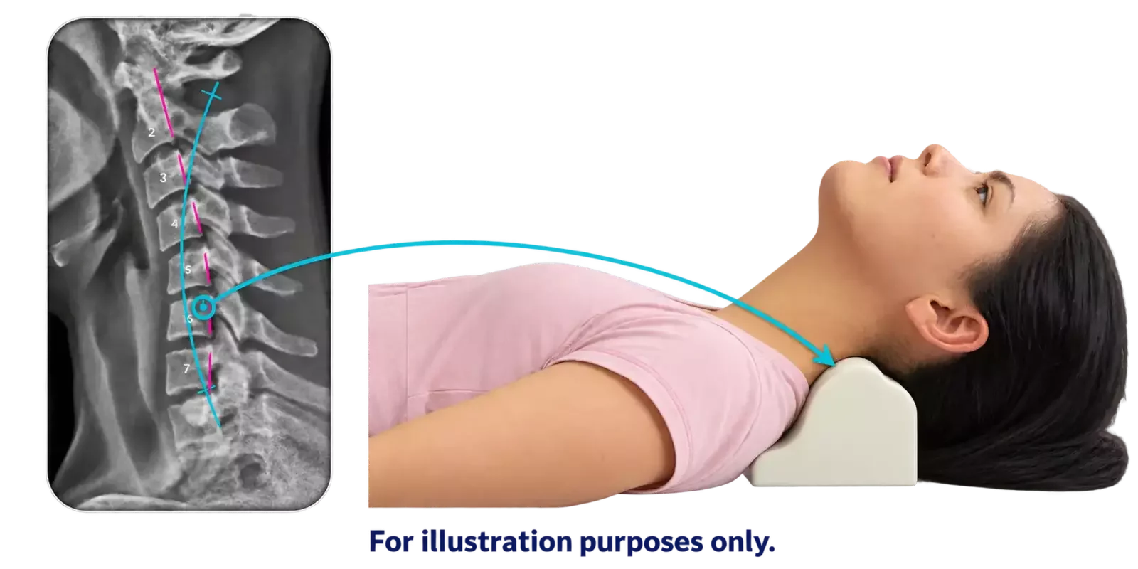 Cervical X-ray with alignment overlays linked to an illustration of a patient lying on a Denneroll neck support for cervical extension traction. For illustration purposes only.