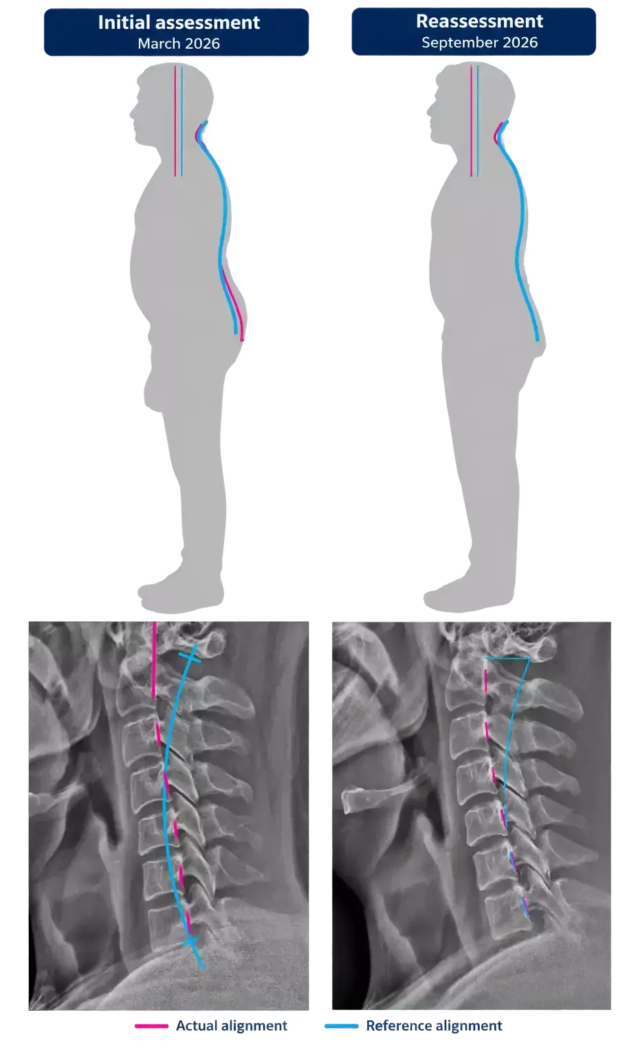 March and September 2026 assessment comparison showing anonymized side-view posture images and cervical X-rays, with pink actual alignment and cyan reference lines.
