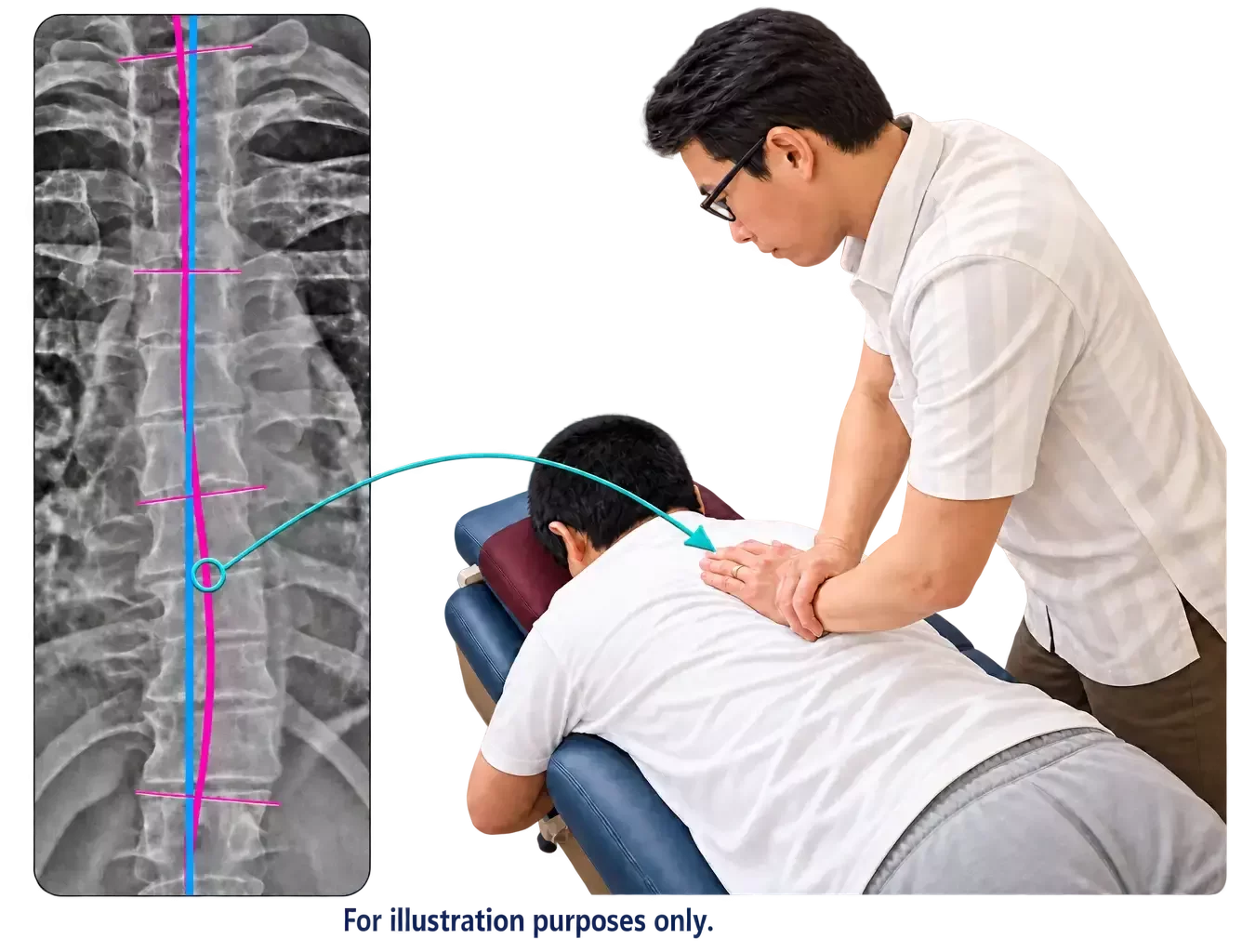 Thoracic X-ray with alignment overlays linked by an arrow to Dr. Leo Quan illustrating a mirror-image thoracic adjustment on a prone patient; for illustration purposes only.