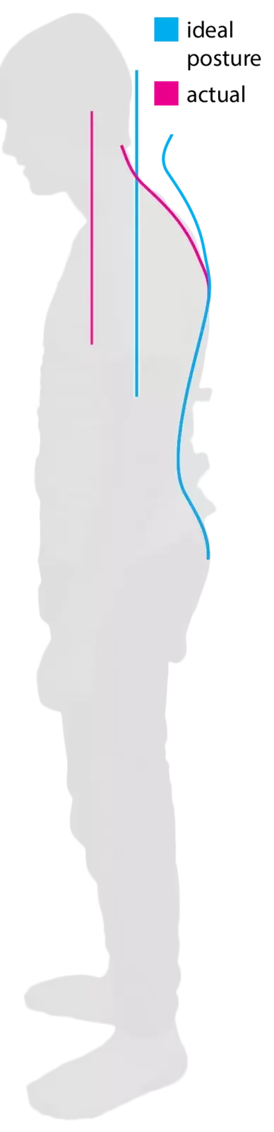 Side-view posture analysis showing measured spinal alignment compared with reference posture lines.